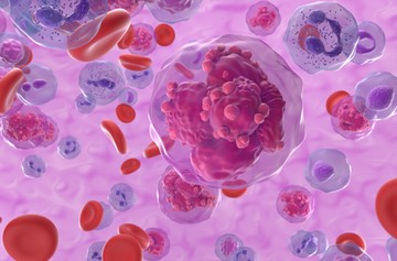 vérszegénység daganat vérrák tumor