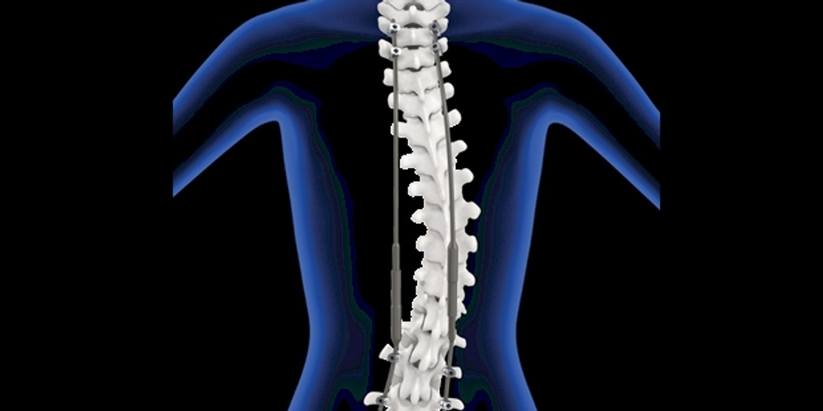 Dwa pręty wszczepione wzdłuż kręgosłupa