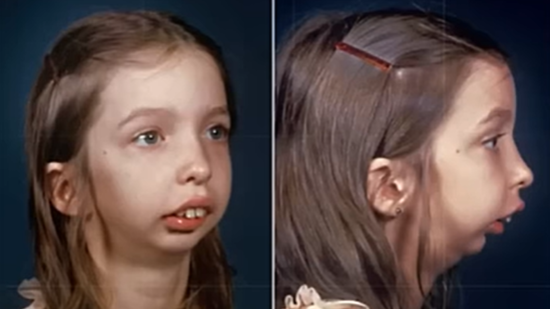 Expert vo videu ukázal aj príklad maloklúzie.