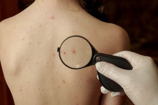 Wzrost zachorowań na ospę wietrzną w Polsce