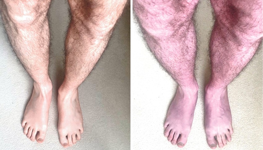 Jedan od simptoma su plave noge