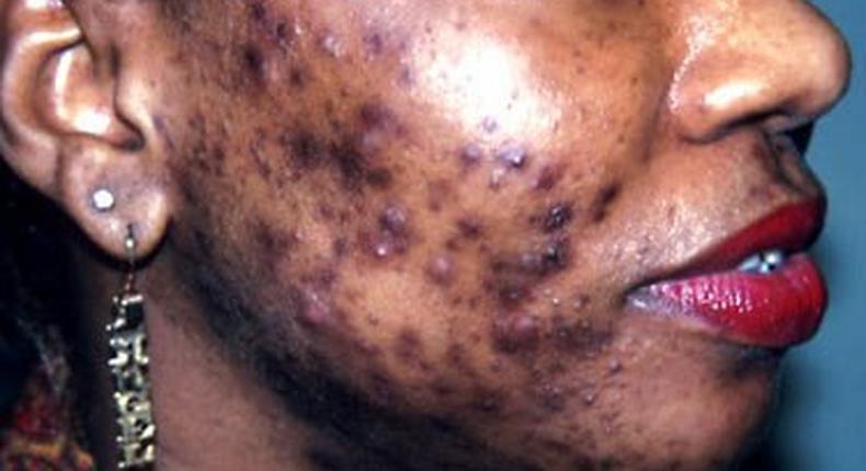 Bad case of adult acne