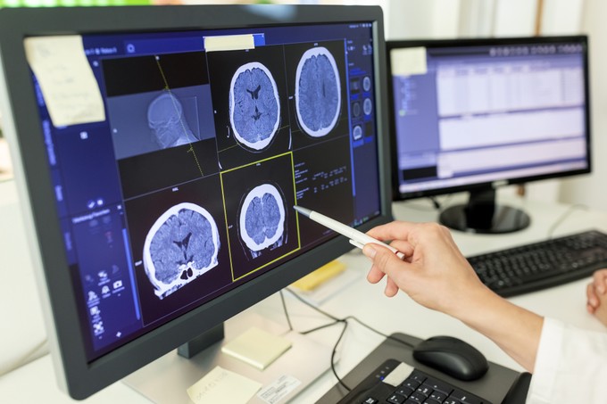 Új kapuk nyíltak meg az agydaganat diagnosztizálására: így növelheti a túlélési arányt