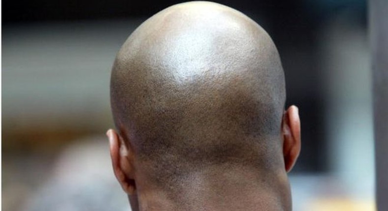 Baldness