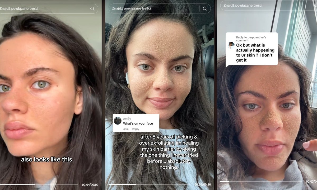 22-latka przestała stosować kosmetyki do twarzy. Nie używa też wody