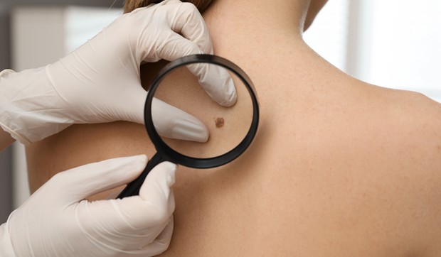 Melanom je zloćudni tumor melanocita 