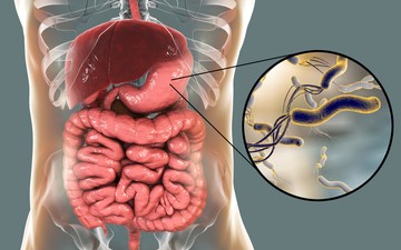 helicobacter pylori, gyomorrák, nyombélfekély, daganat