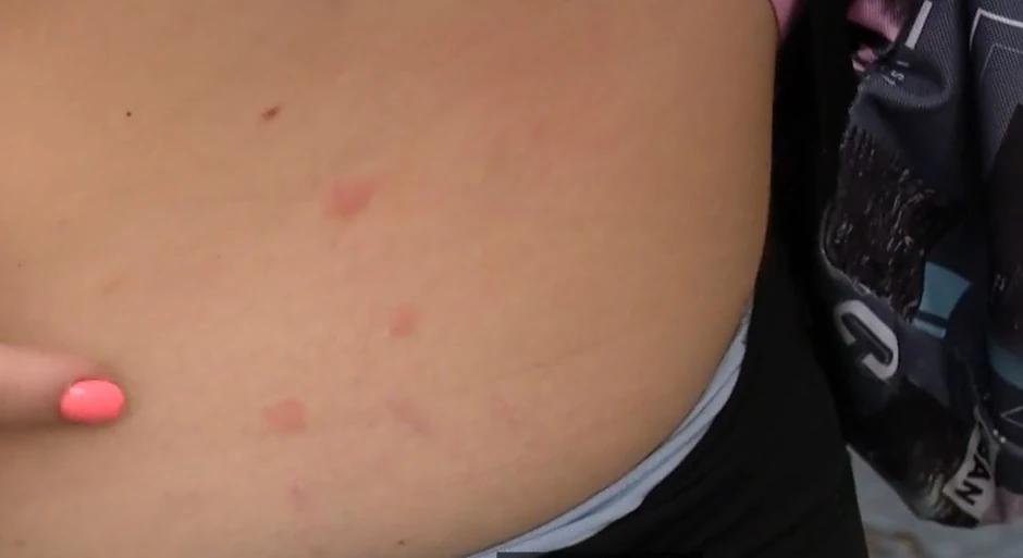 Ujedi stenica na jednoj od stanarski zgrade