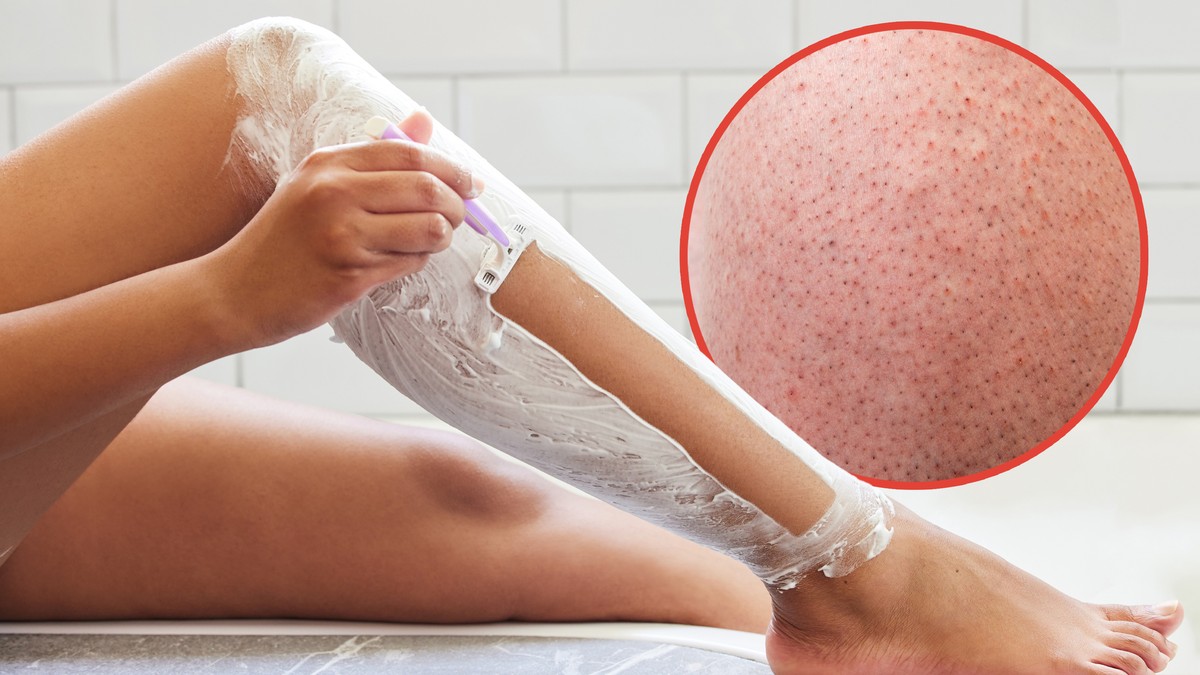 Korišćenje starog ili tupog brijača može da izazove kvržice od brijanja