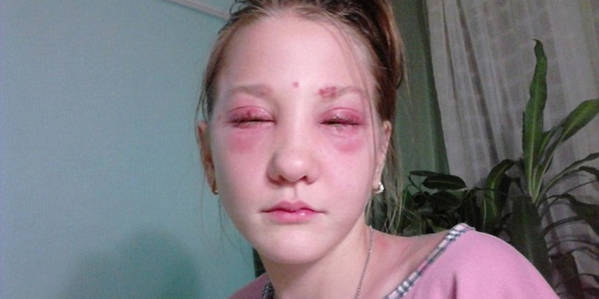 Masha Kuznetsova prawie oslepła po zabiegu kosmetycznym