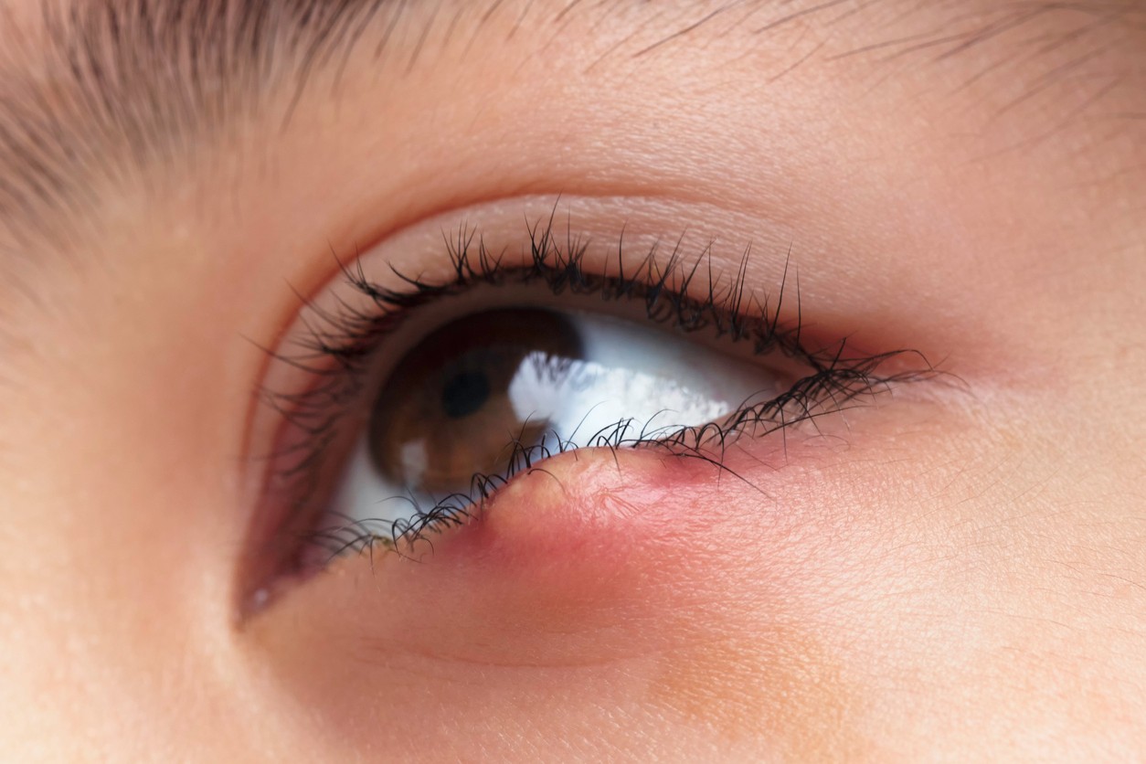 Žltý výtok môže byť príznakom očného jačmeňa. (ilustračné foto)
