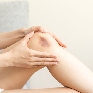 Kék-lila foltok a lábon beütés nélkül – mi okozhatja? Az orvos válaszol