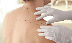 Pięć nietypowych oznak nowotworów skóry