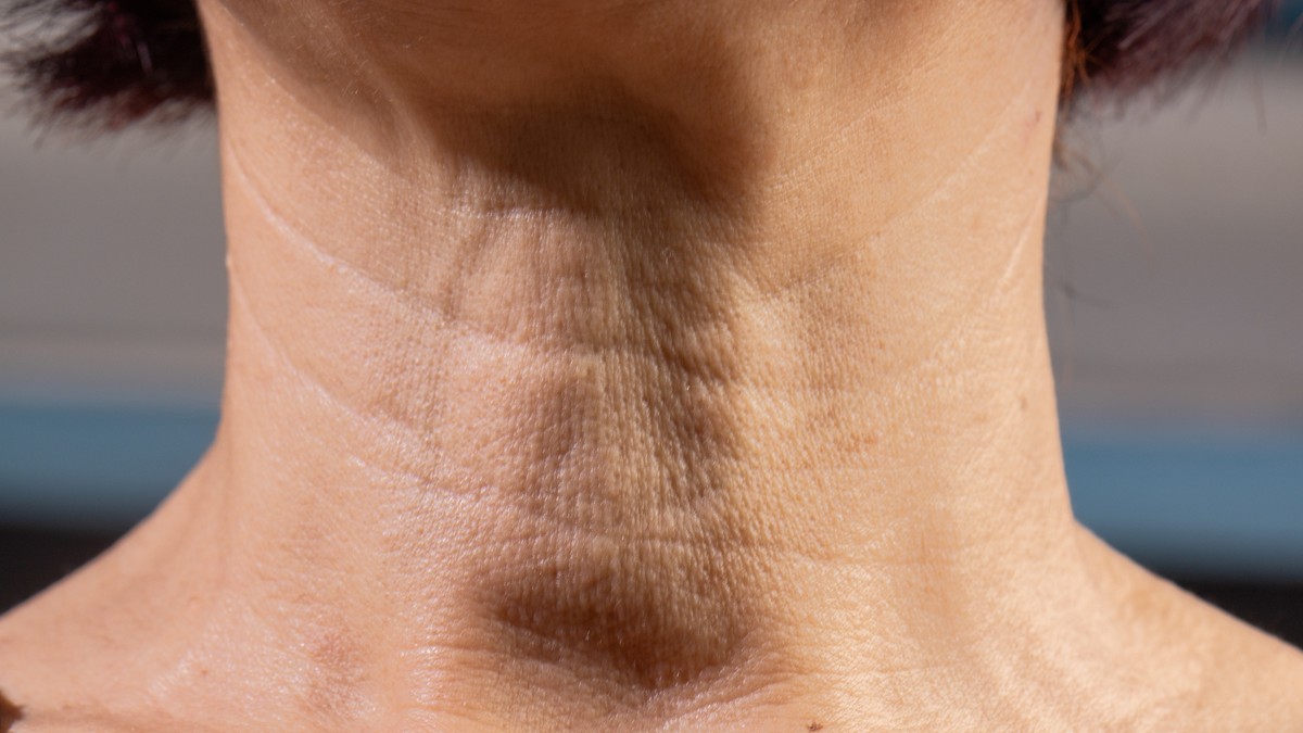 "Ćureći vrat" na koži je estetski termin za opuštenu kožu i nakupljene masnoće ispod brade i na vratu