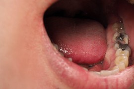 ČUVENI SRPSKI ZUBAR UPOZORAVA: "Ne zanemarujte ovaj SIMPTOM, možete začas da ostanete BEZ ZUBA", evo kako PRAZNIČNA JELA nanose veliku štetu, samo je JEDNO PIĆE "bezopasno"