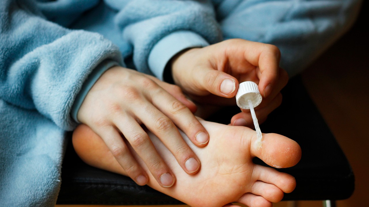 Mnohé vírusové bradavice časom ustúpia spontánne.