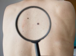 Rak skóry atakuje ze zdwojoną siłą. Dlaczego?