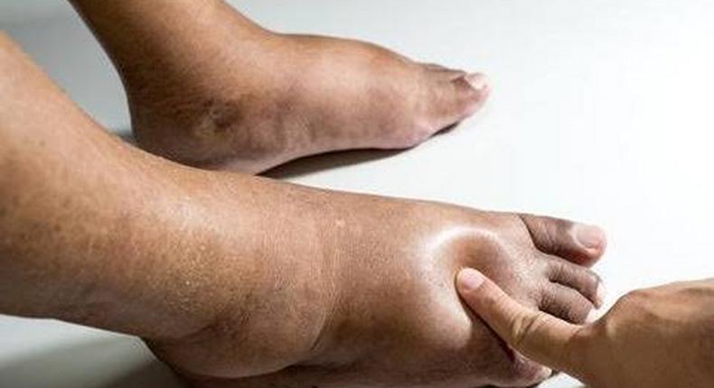 Swollen legs may be as a result of an underlying medical condition [Dr Segal]