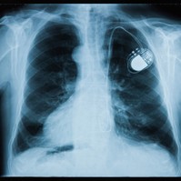 Pacemaker, defibrillátor beültetése: ezekben az esetekben szükséges