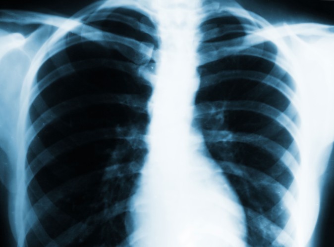 Jak można zakazić się gruźlicą?