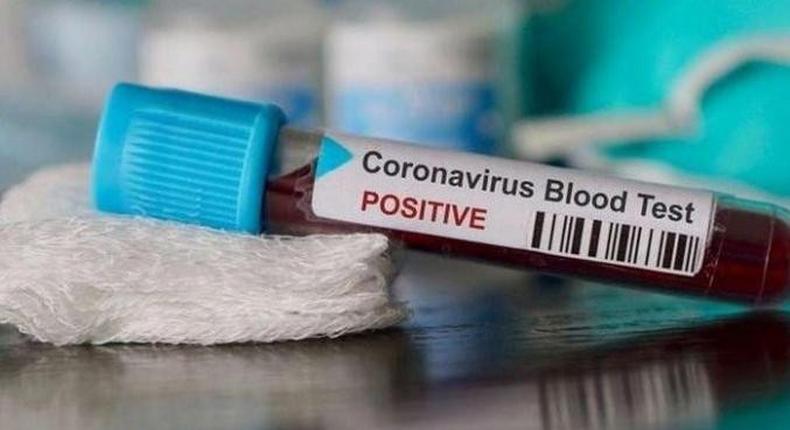 COVID-19 : 130 NOUVEAUX CAS, 137 GUÉRIS ET 49 PATIENTS EN RÉA