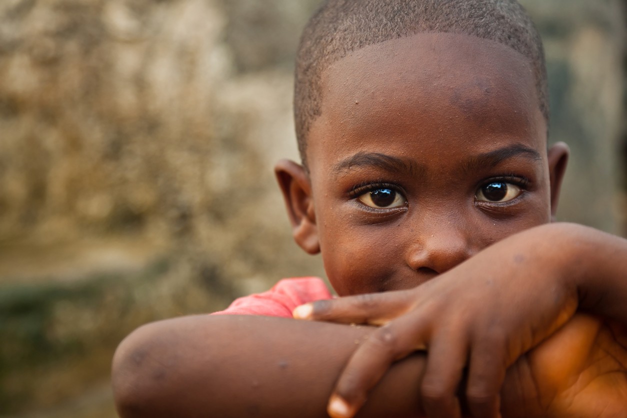 Africké deti kosí záhadné ochorenie.