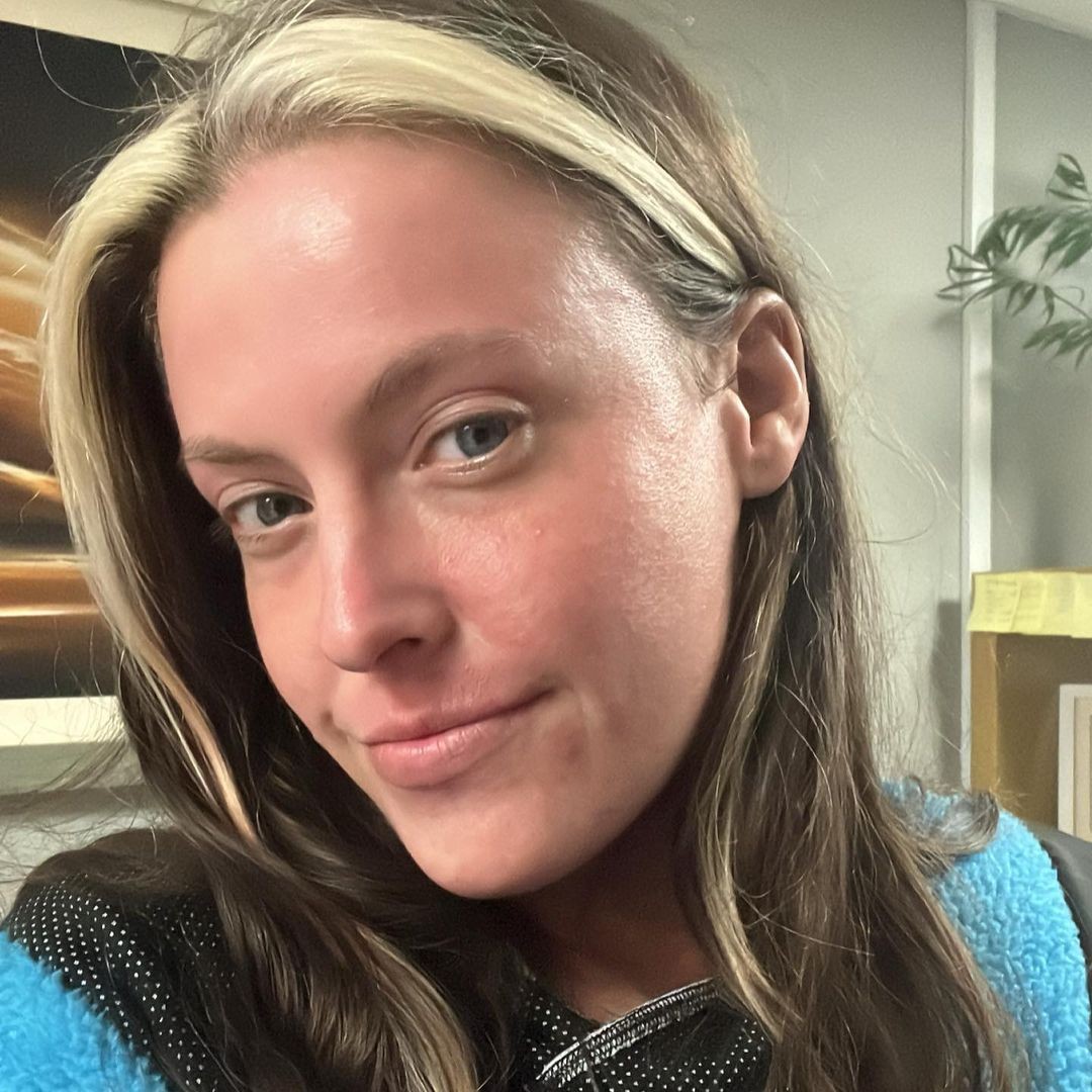 Daisy trpela ekzémom 20 rokov a kvôli svojmu kožnému stavu nechcela vychádzať z domu. 