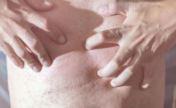 Potówki czy może wysypka? Jak odróżnić zmiany na skórze?