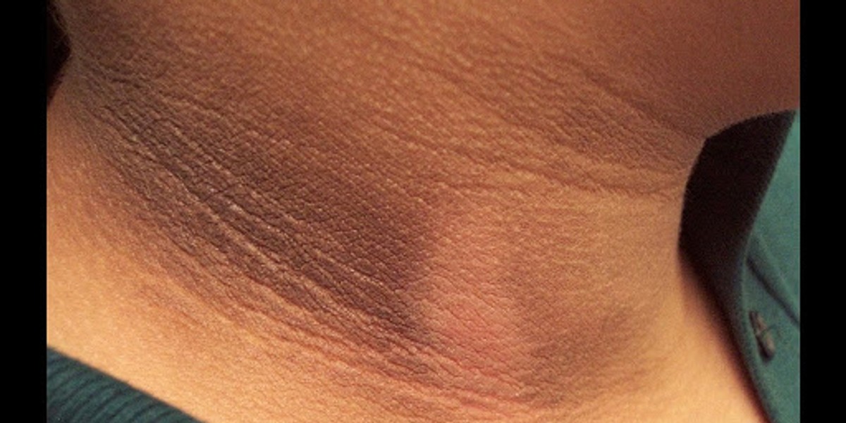 Skin hyperpigmentation in pregnancy: Causes, prevention, remedies