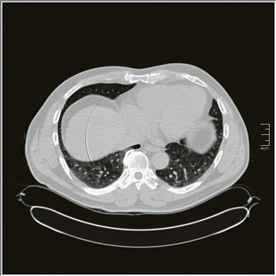Rana faza (0. do 4. dan) - pojedinačne GGO, neka crazy paving, nizak skor