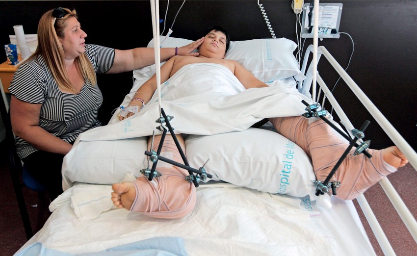 Žena kojoj su transplatnirane obe noge