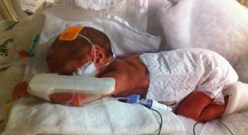 Baby born with congenital pneumonia