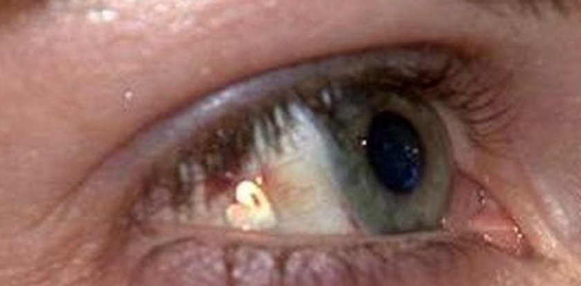Platynowy implant w oku. Hit czy ohyda?
