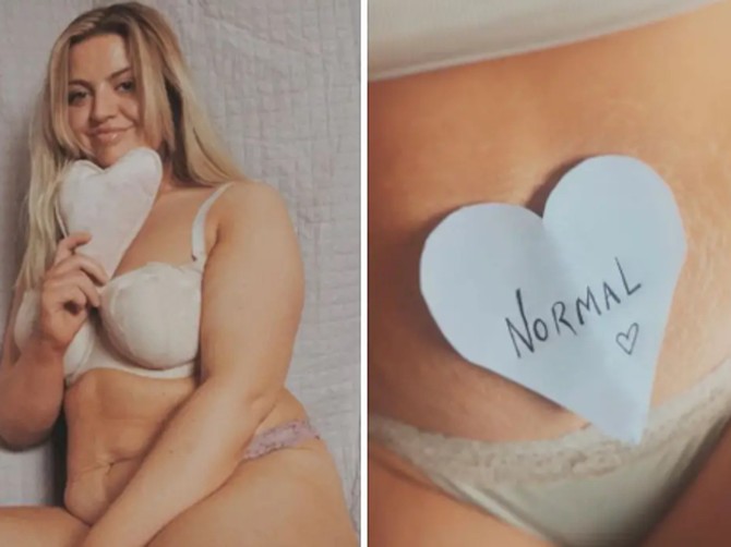 Mama pokayuje strije i celulit