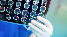 Trzy objawy udaru mózgu, których nie możesz zlekceważyć
