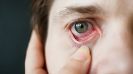 Najbardziej dokuczliwe objawy alergii sezonowej. Jak sobie z nimi radzić?