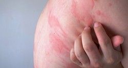 Fotoallergiás reakcióA napfény nem önmagában okoz gondot, hanem bizonyos kozmetikumokkal, gyógyszerekkel együtt. A tünetek – vörös, viszkető foltok – jellemzően 1–3 nap késéssel jelentkeznek.