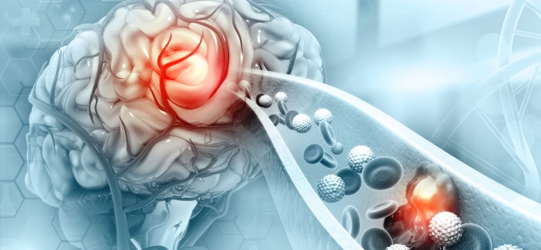 Udar mózgu jest drugą po chorobach serca najczęstszą przyczynę śmierci Polaków. OBJAWY