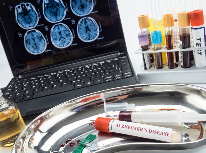 Mérföldkő az Alzheimer-kór diagnózisában – itt az első vérvizsgálati teszt, amit az FDA is jóváhagyott
