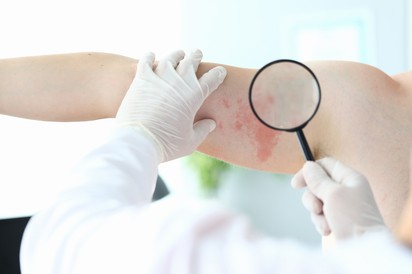 Bőrgomba, gombás bőrfertőzés: tünetei, okai és kezelési lehetőségei