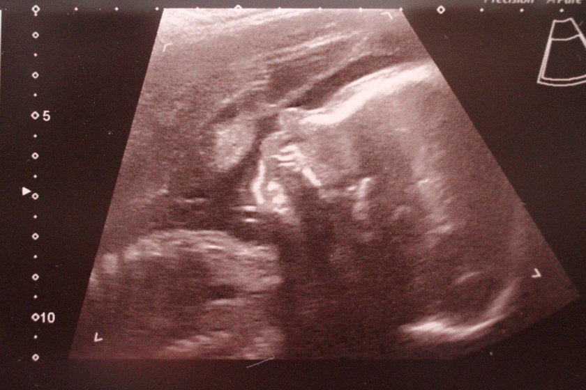 Para z Wielkiej Brytanii dzięki in vitro po 14 poronieniach doczekała się dziecka