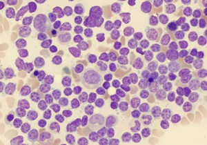 Krvna slika hronične limfocitne leukemije (HLL), analizirana mikroskopom, originalno uvećanje 1000x