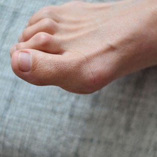 Ezzel a 4 módszerrel kerülheti el a kalapácsujj műtétet