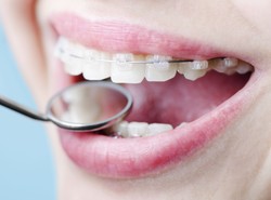 Aparaty ortodontyczne dla dorosłych – jak wybrać właściwy?