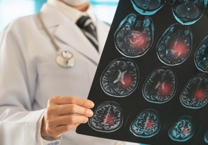 Lakunarni moždani udar  je po život opasno medicinsko stanje 