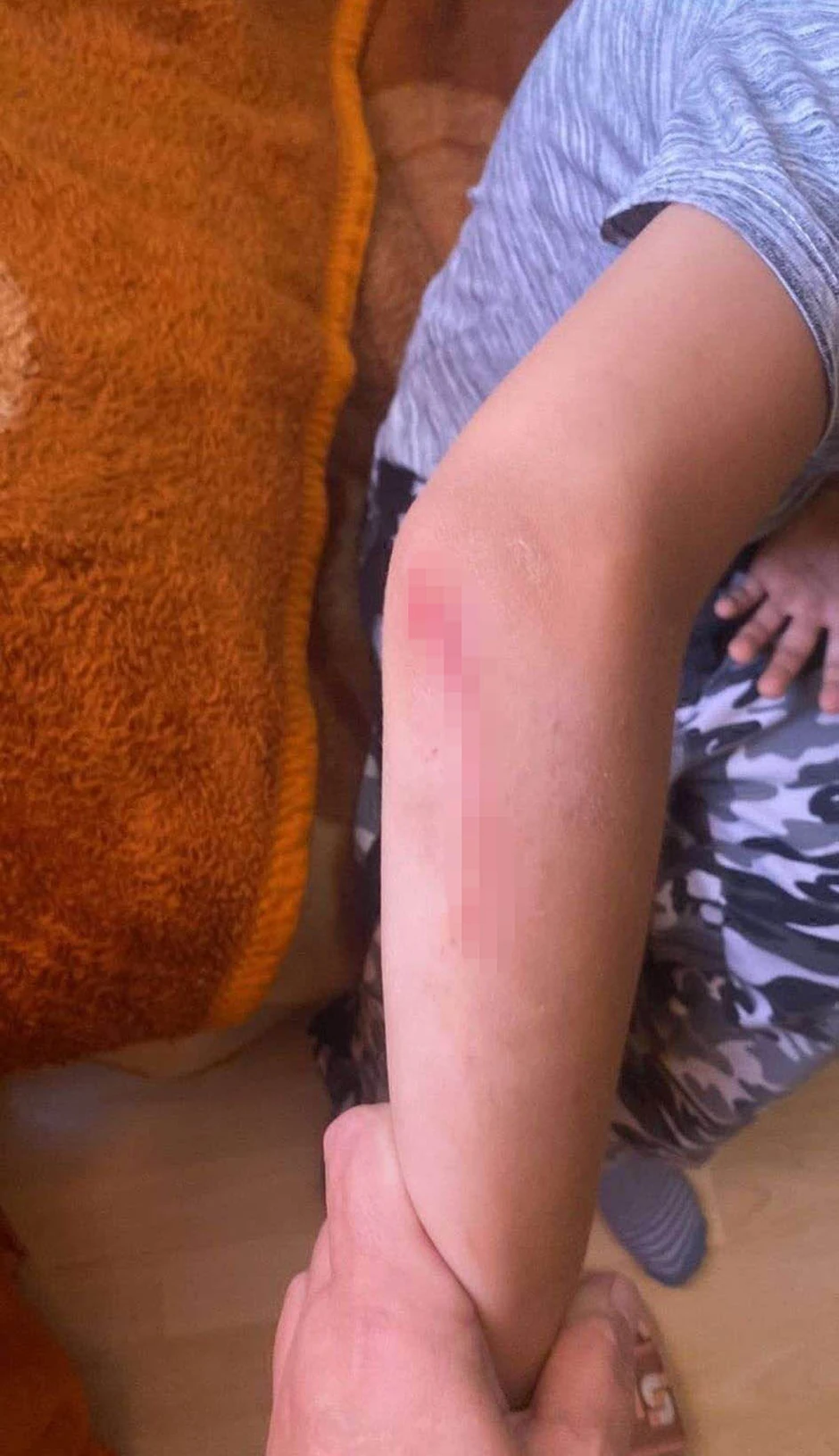 Fotografija povreda dečaka koje nam je dostavila njegova majka