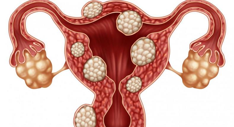 Everything you need to know about fibroids. [medicalnewstoday]