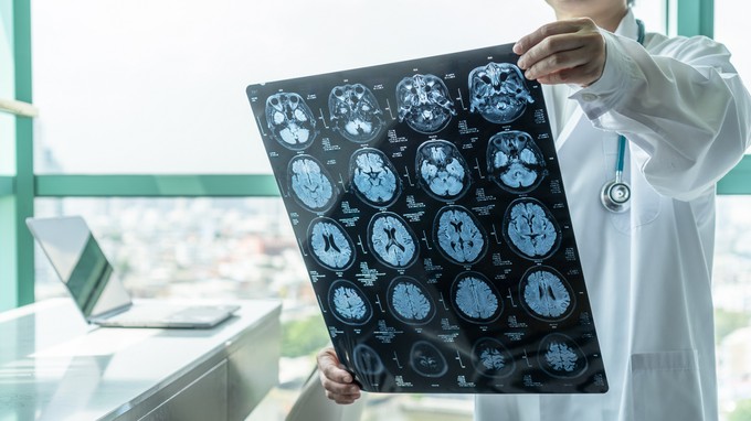 Rákgyógyszer az Alzheimer-kór gyógyításában – kutatók szerint mérföldkőhöz érkeztek