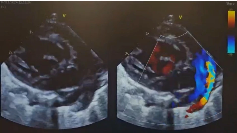 Intervencija na srcu prevremeno rođene bebe