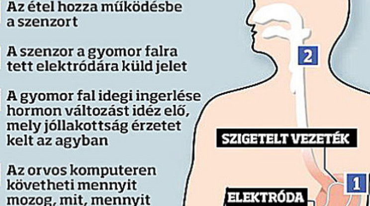 Hihetetlen: Itt a gyomorpacemaker